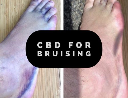 CBD for Bruising